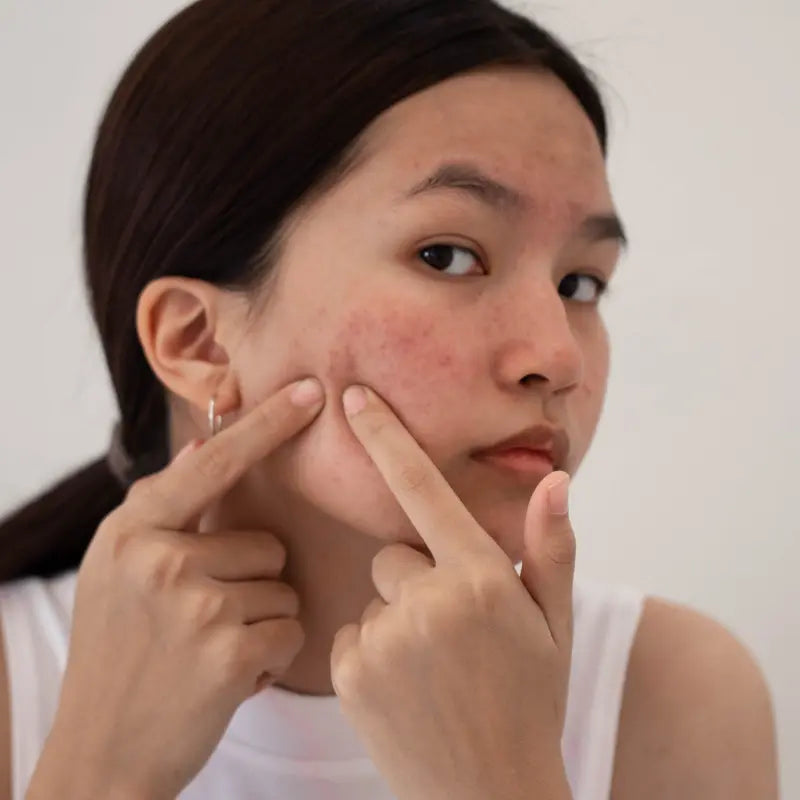 Soluciones coreanas para piel con tendencia acneica: ingredientes calmantes y purificantes que reducen imperfecciones sin agredir la piel.